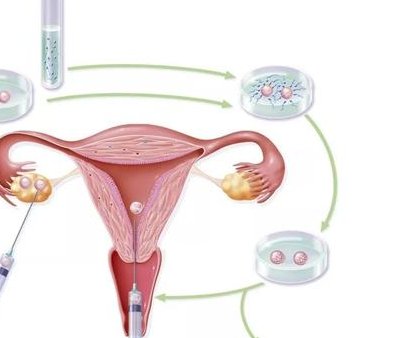 汕头试管一代二代三代区别价格？